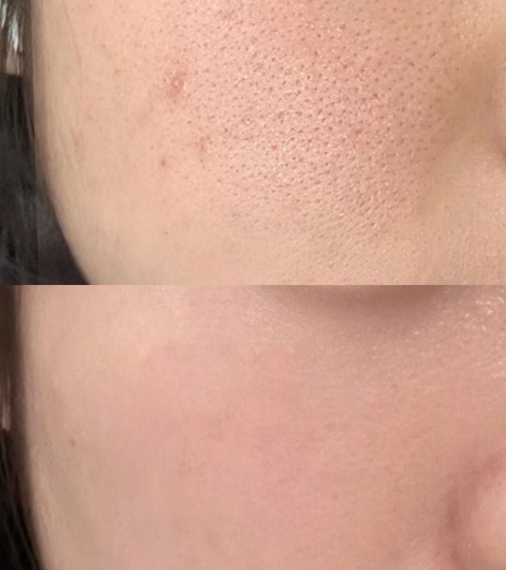 Pelle prima del trattamento LuminMask