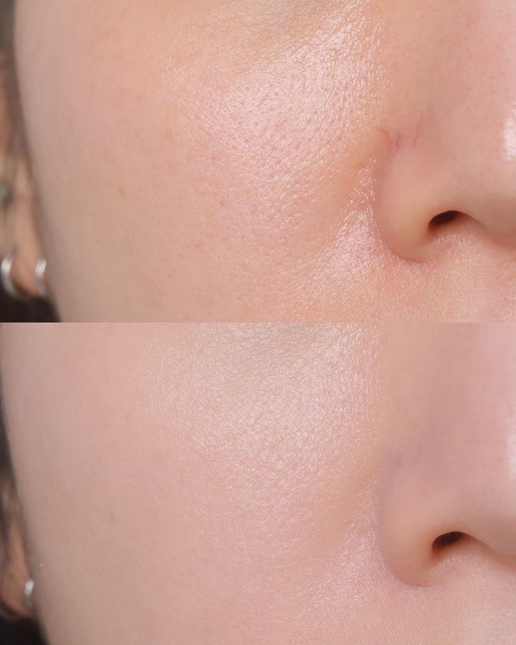 Pelle dopo il trattamento LuminMask